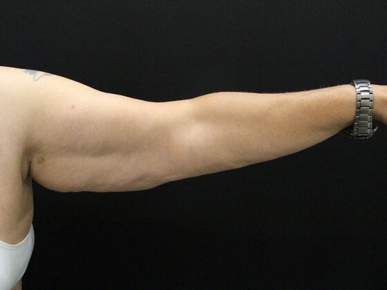 Arm Lift: Case 24 - Before