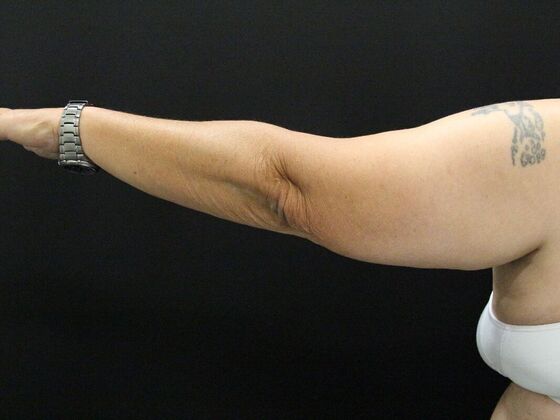 Arm Lift: Case 24 - Before