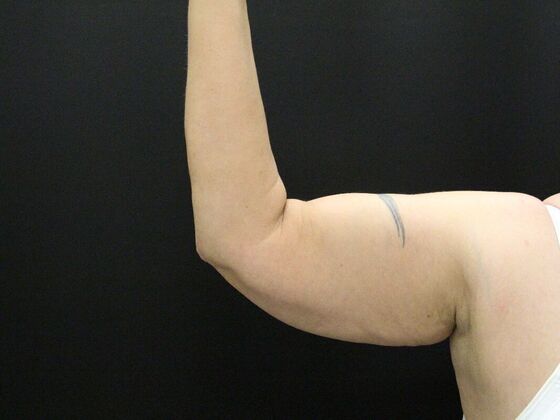Arm Lift: Case 24 - Before