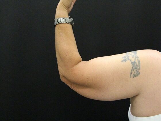 Arm Lift: Case 24 - Before