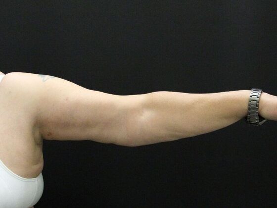 Arm Lift: Case 24 - After