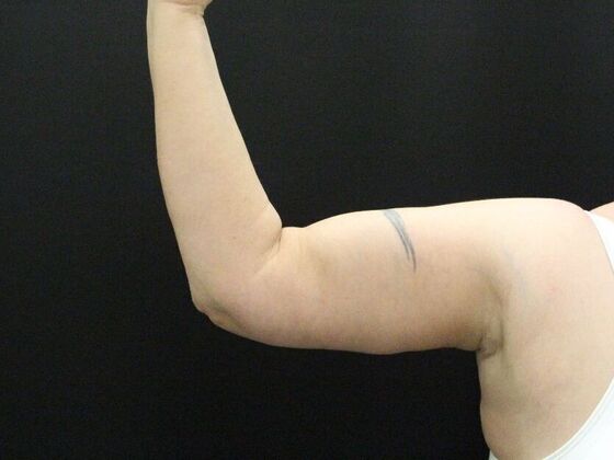 Arm Lift: Case 24 - After