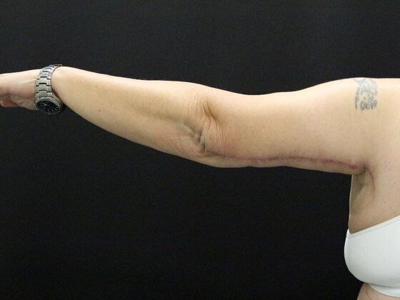 Arm Lift: Case 24 - After