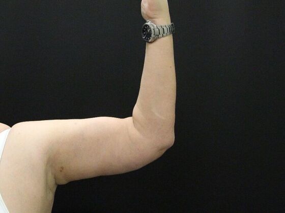 Arm Lift Case 24 - After