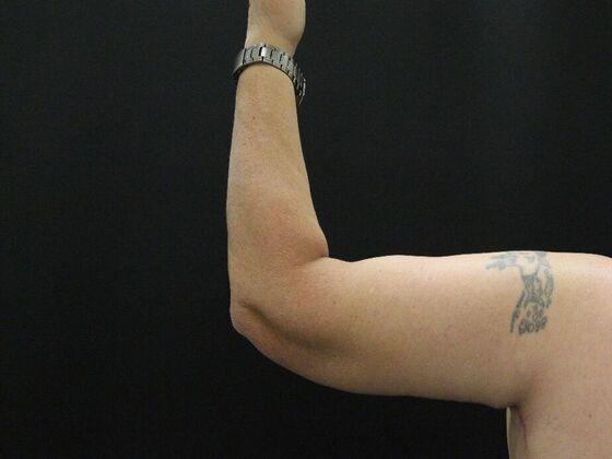 Arm Lift: Case 24 - After