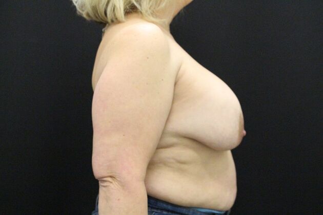 Breast Revision: Case 11 - Before