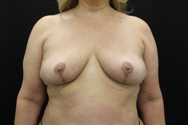 Breast Revision Case 11 - After