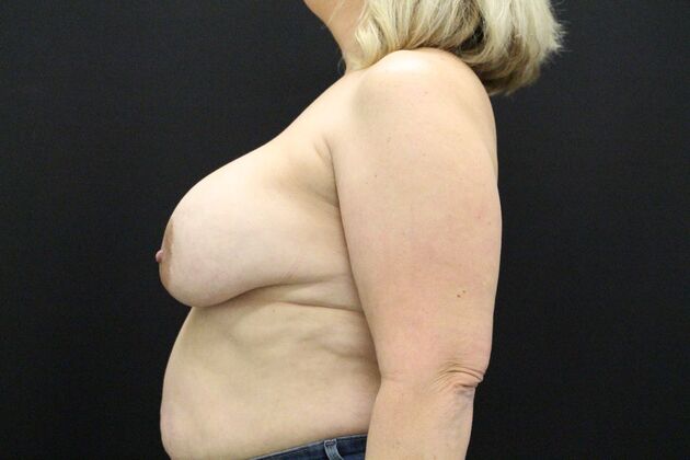 Breast Revision: Case 11 - Before