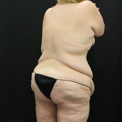 Tummy Tuck: Case 44 - Before