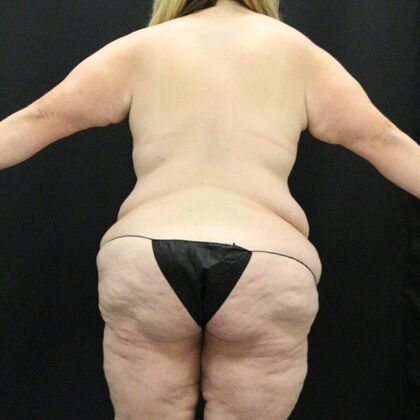 Tummy Tuck: Case 44 - Before