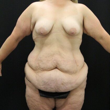 Tummy Tuck Case 44 - Before