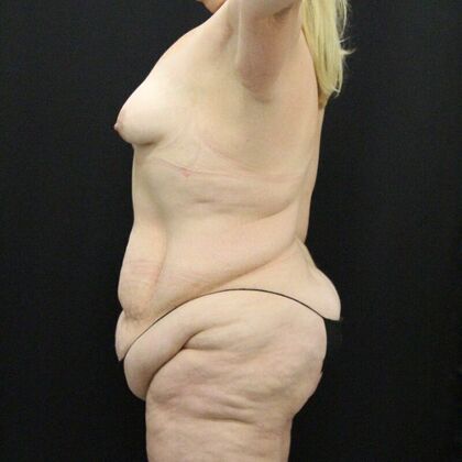 Tummy Tuck: Case 44 - Before