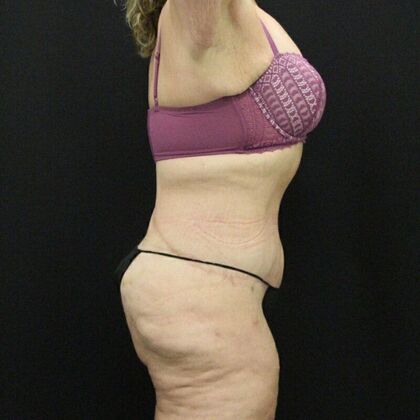 Tummy Tuck: Case 44 - After