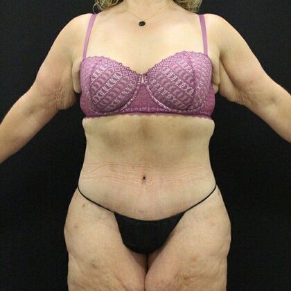 Tummy Tuck Case 44 - After