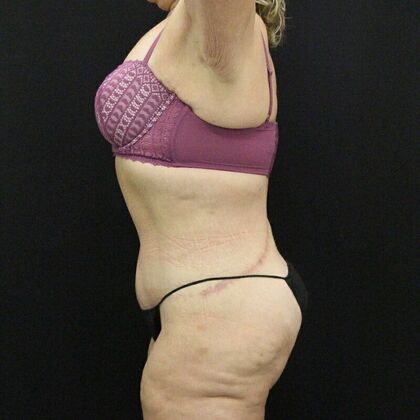 Tummy Tuck: Case 44 - After