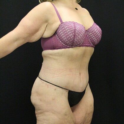 Tummy Tuck: Case 44 - After