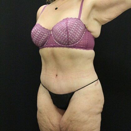 Tummy Tuck: Case 44 - After