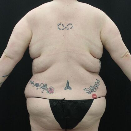 Tummy Tuck: Case 45 - Before