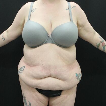 Tummy Tuck Case 45 - Before