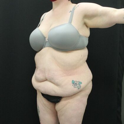 Tummy Tuck: Case 45 - Before