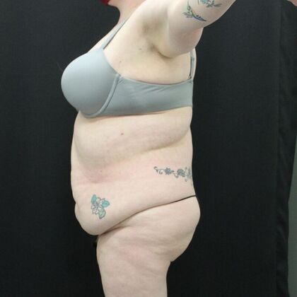 Tummy Tuck: Case 45 - Before