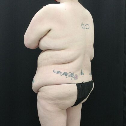 Tummy Tuck: Case 45 - Before