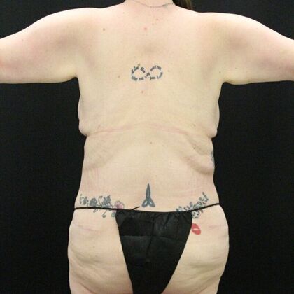 Tummy Tuck: Case 45 - After