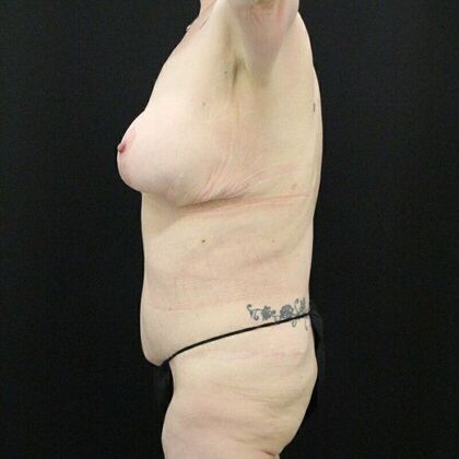 Tummy Tuck: Case 45 - After