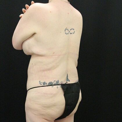 Tummy Tuck: Case 45 - After