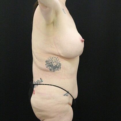 Tummy Tuck: Case 45 - After