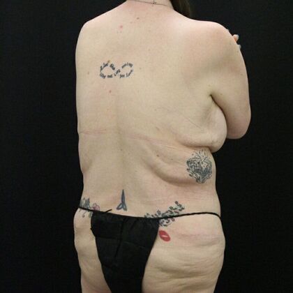 Tummy Tuck: Case 45 - After