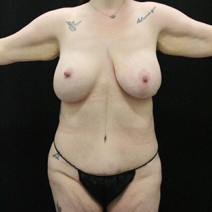 Tummy Tuck Case 45 - After