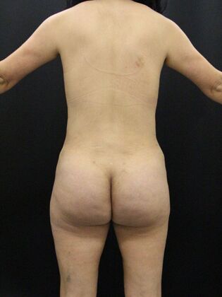 Tummy Tuck: Case 46 - After