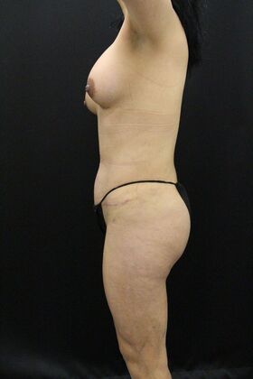 Tummy Tuck: Case 46 - After