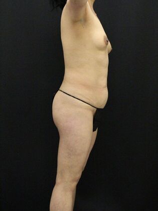 Tummy Tuck: Case 46 - Before