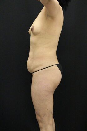 Tummy Tuck: Case 46 - Before