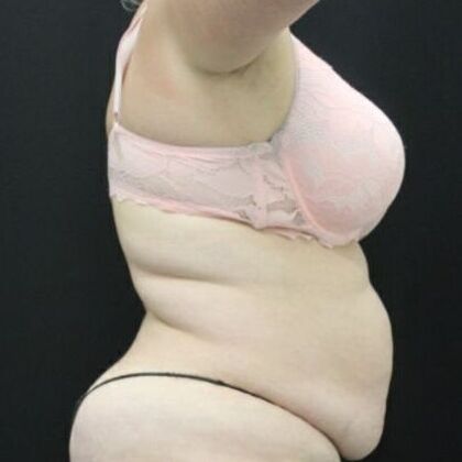 Tummy Tuck: Case 47 - Before