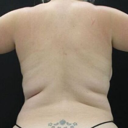 Tummy Tuck: Case 47 - Before