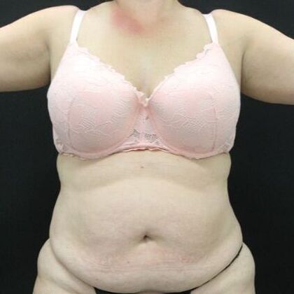 Tummy Tuck Case 47 - Before