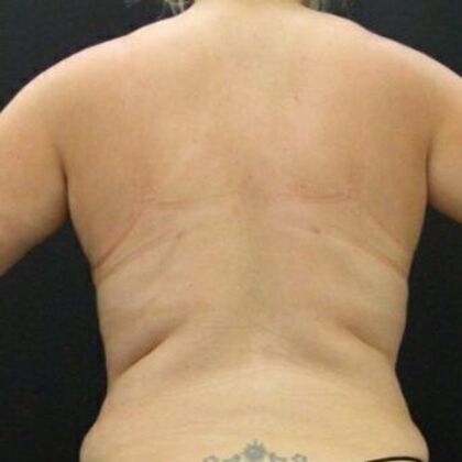 Tummy Tuck: Case 47 - After