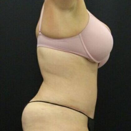 Tummy Tuck: Case 47 - After