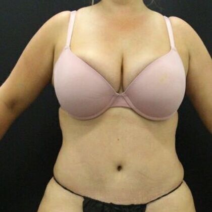 Tummy Tuck Case 47 - After