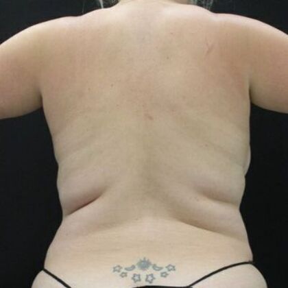 Liposuction Case 41 - Before