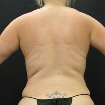 Liposuction Case 41 - After