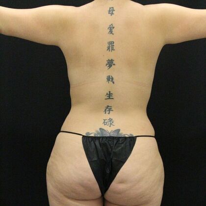 Tummy Tuck: Case 48 - After