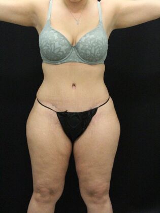 Tummy Tuck Case 48 - After