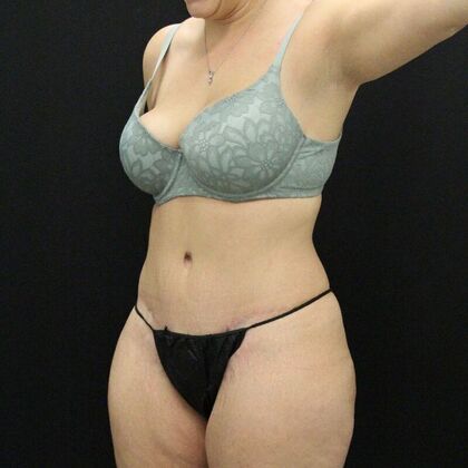 Tummy Tuck: Case 48 - After