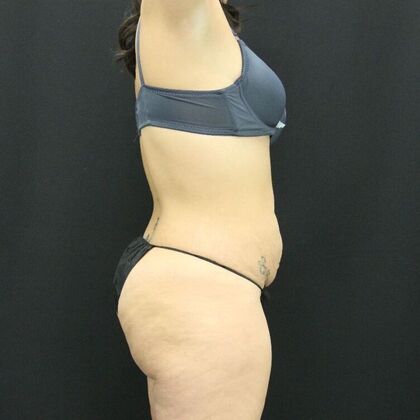 Tummy Tuck: Case 48 - Before