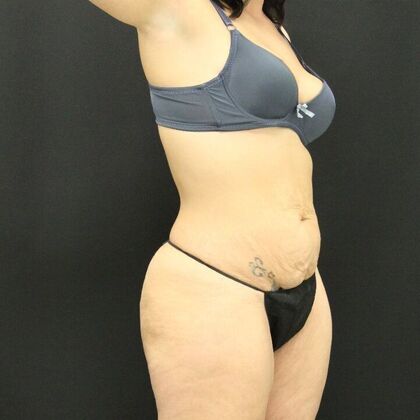 Tummy Tuck: Case 48 - Before