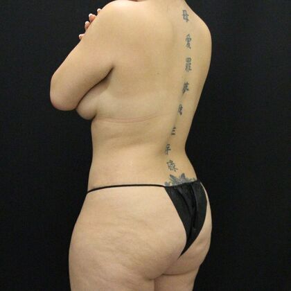 Liposuction: Case 42 - After